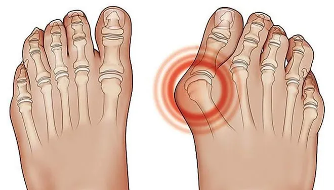 Bentuk Kaki Mengalami Asam Urat